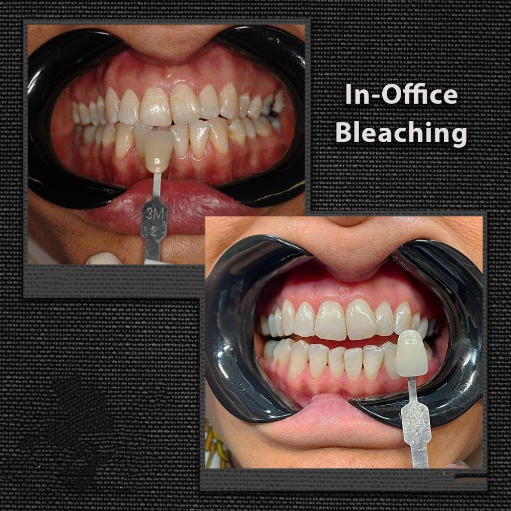 بلیچینگ دندان